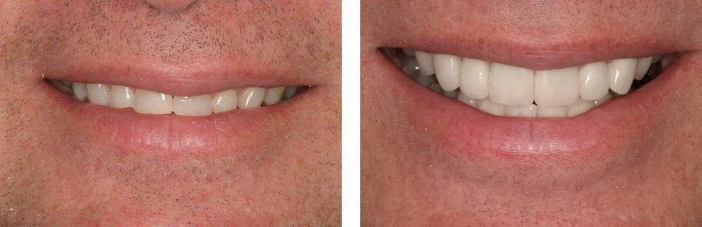 before and after teeth