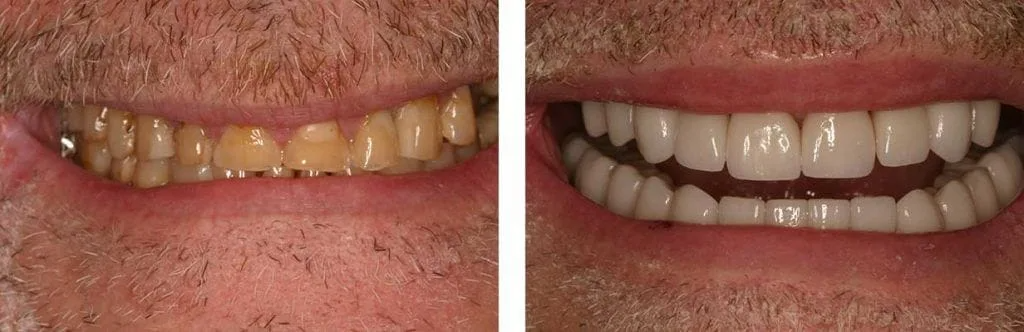 before and after teeth