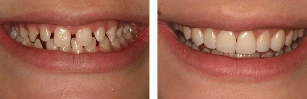 before and after teeth