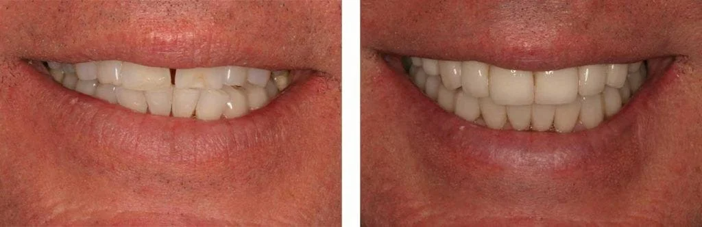 before and after teeth