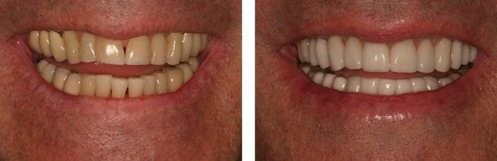 before and after teeth