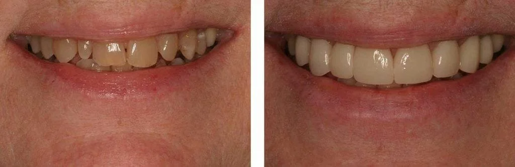 before and after teeth