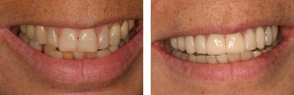 before and after teeth