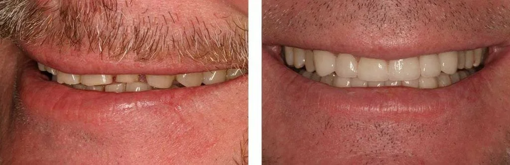 before and after teeth